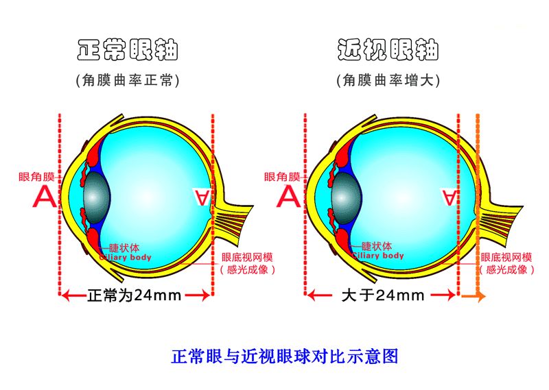 近視是怎樣形成的？視普泰驗(yàn)光師培訓(xùn)學(xué)院帶您走進(jìn)了解