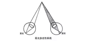 驗光師培訓不同情況下矯正屈光參差的方法及驗光配鏡原則