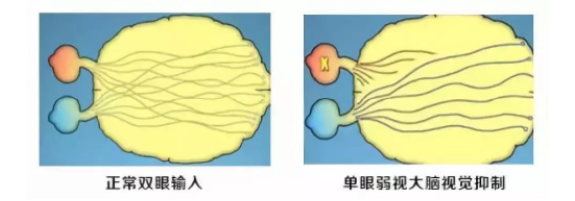 眼視光科普成人的弱斜視會(huì)影響正常生活嗎？